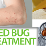 bed-bug-bites-bites 3